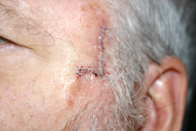 close up of sutures
